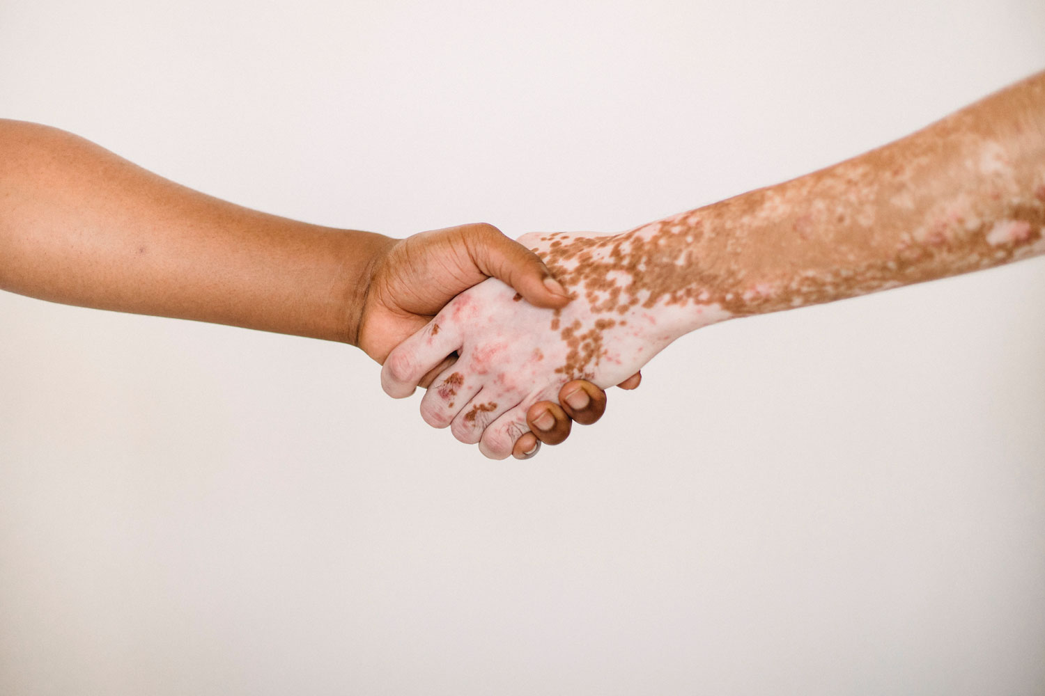 World Vitiligo Day 2025: ਕੀ ਇਹ ਬਿਮਾਰੀ ਛੂਹਣ ਨਾਲ ਹੁੰਦੀ ਹੈ? ਚਿੱਟੇ ਧੱਬੇ ਦੀ ਬਿਮਾਰੀ ਦਾ ਕਾਲਾ ਸੱਚ ਜਾਣੋ